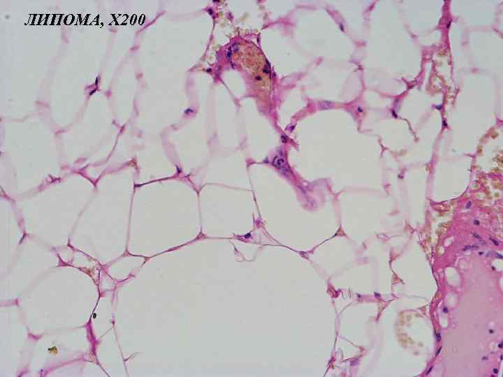 ЛИПОМА, Х 200 
