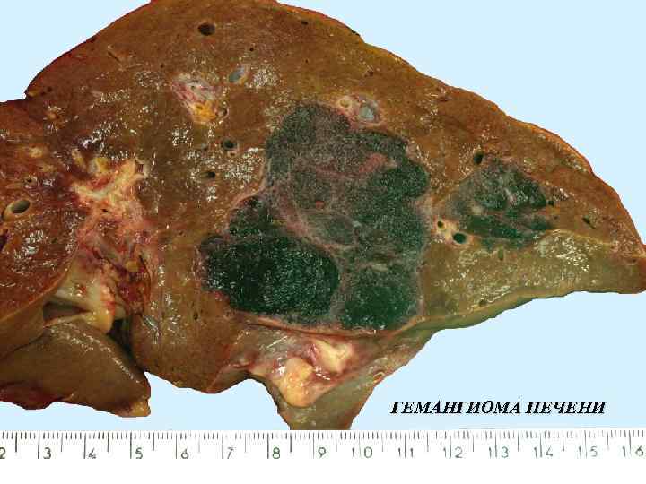 ГЕМАНГИОМА ПЕЧЕНИ 