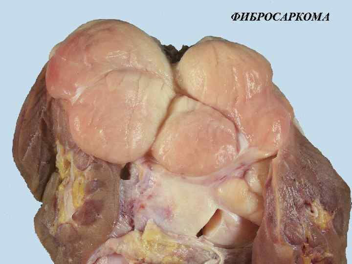 ФИБРОСАРКОМА 