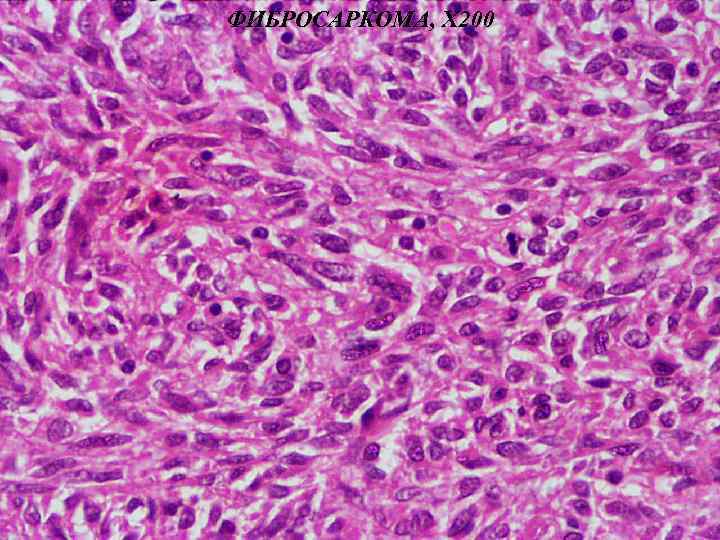 G1 опухоли. Фибросаркома гистологическая картинка. Low Grade Fibrosarcoma.