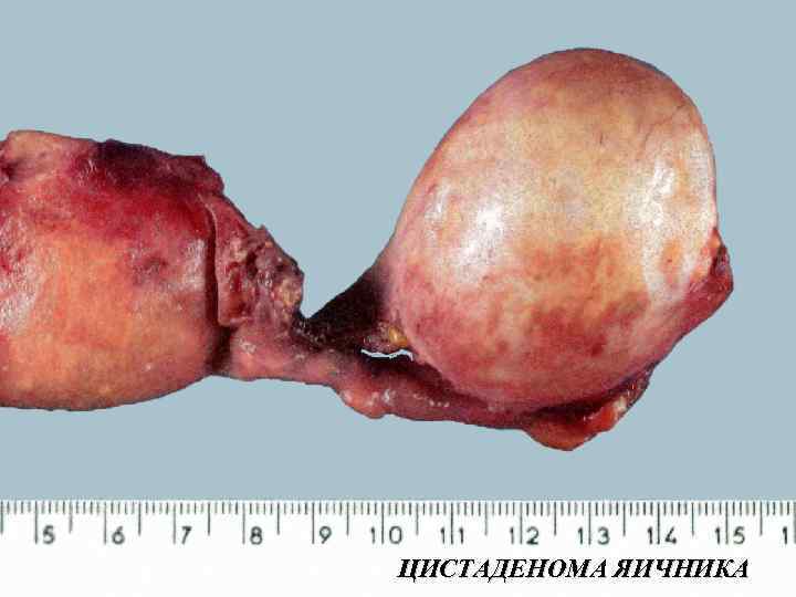 ЦИСТАДЕНОМА ЯИЧНИКА 