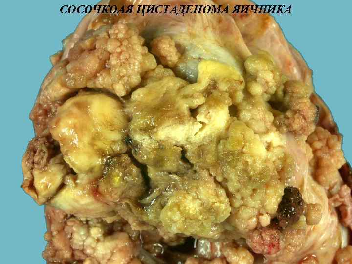 СОСОЧКОАЯ ЦИСТАДЕНОМА ЯИЧНИКА 
