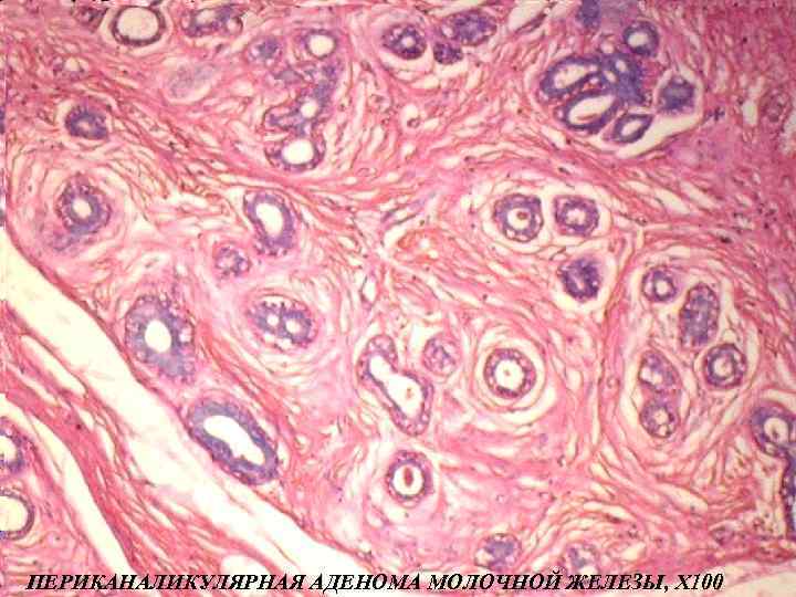 ПЕРИКАНАЛИКУЛЯРНАЯ АДЕНОМА МОЛОЧНОЙ ЖЕЛЕЗЫ, Х 100 