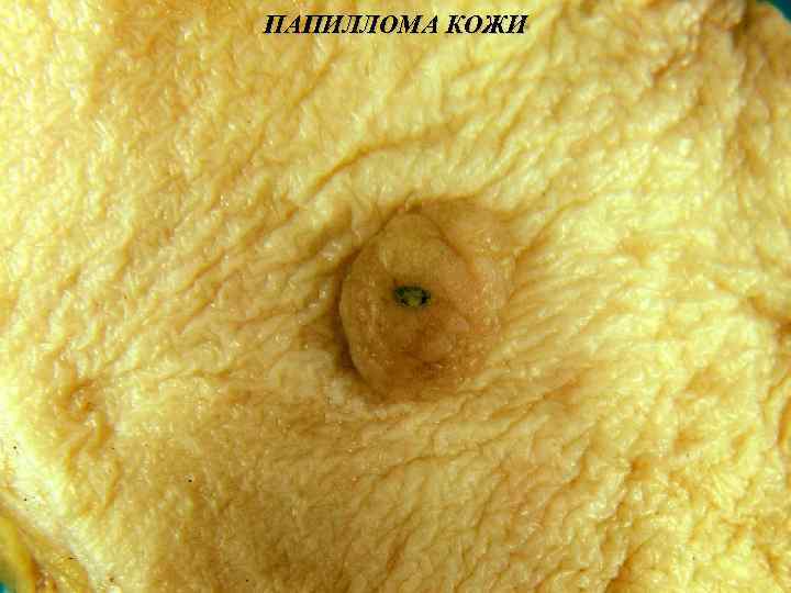 ПАПИЛЛОМА КОЖИ 