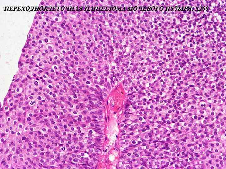 ПЕРЕХОДНОКЛЕТОЧНАЯ ПАПИЛЛОМА МОЧЕВОГО ПУЗЫРЯ, Х 200 