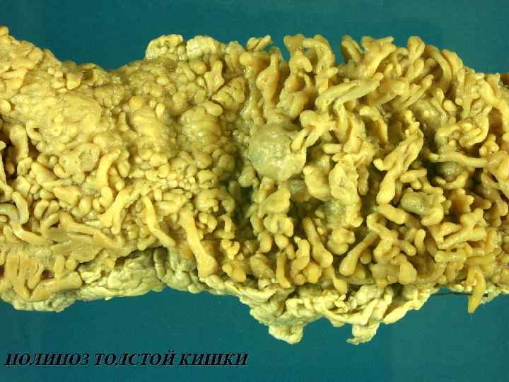 ПОЛИПОЗ ТОЛСТОЙ КИШКИ 