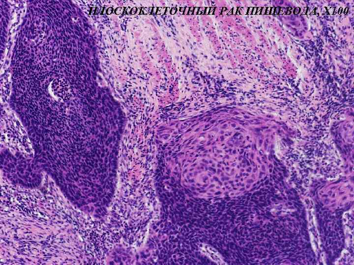 ПЛОСКОКЛЕТОЧНЫЙ РАК ПИЩЕВОДА, Х 100 