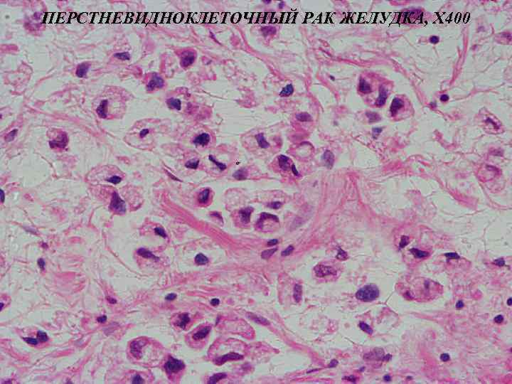 ПЕРСТНЕВИДНОКЛЕТОЧНЫЙ РАК ЖЕЛУДКА, Х 400 