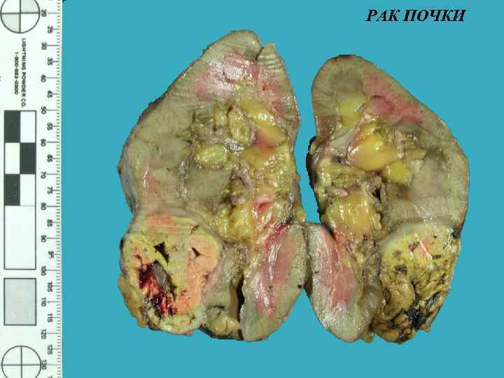 РАК ПОЧКИ 