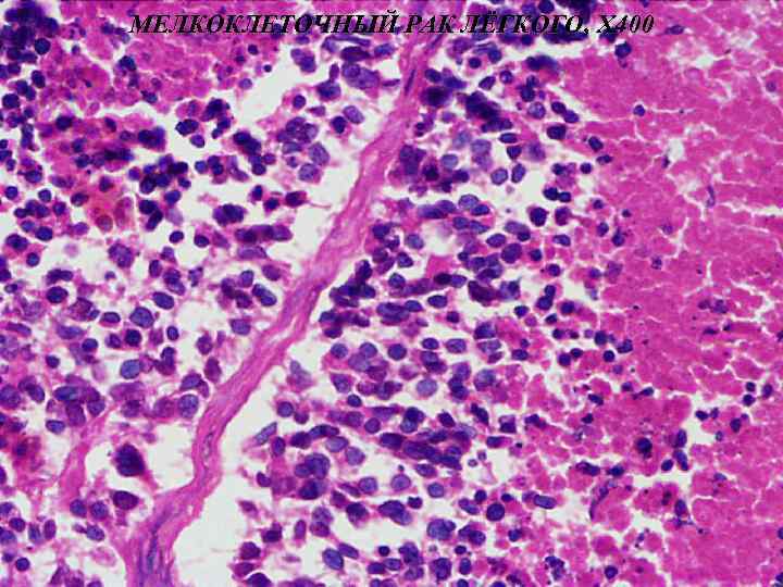 МЕЛКОКЛЕТОЧНЫЙ РАК ЛЁГКОГО, Х 400 