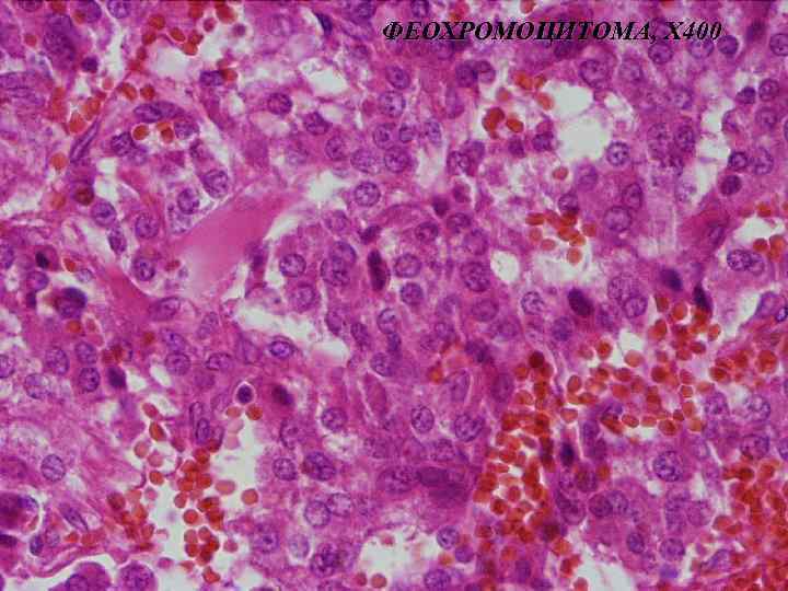 ФЕОХРОМОЦИТОМА, Х 400 