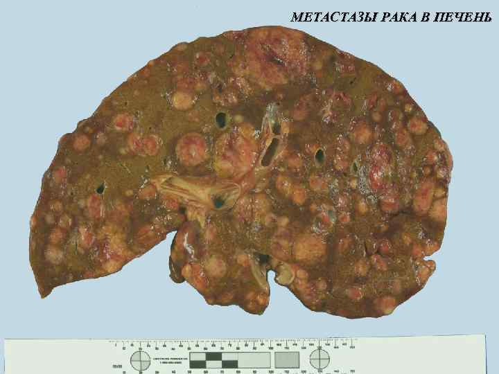 МЕТАСТАЗЫ РАКА В ПЕЧЕНЬ 