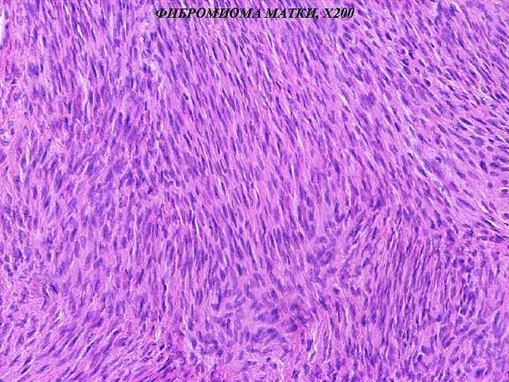 ФИБРОМИОМА МАТКИ, Х 200 