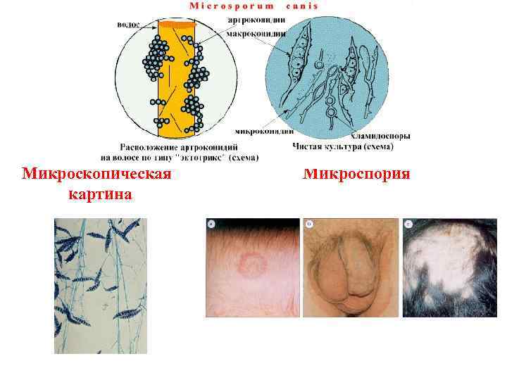 Микроскопическая  Микроспория картина 