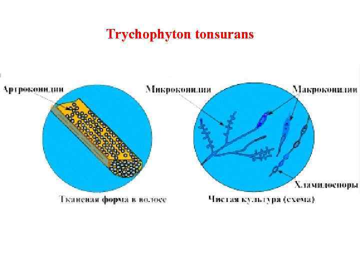 Trychophyton tonsurans 