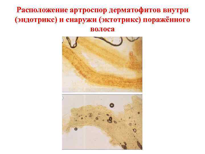  Расположение артроспор дерматофитов внутри (эндотрикс) и снаружи (эктотрикс) поражённого    
