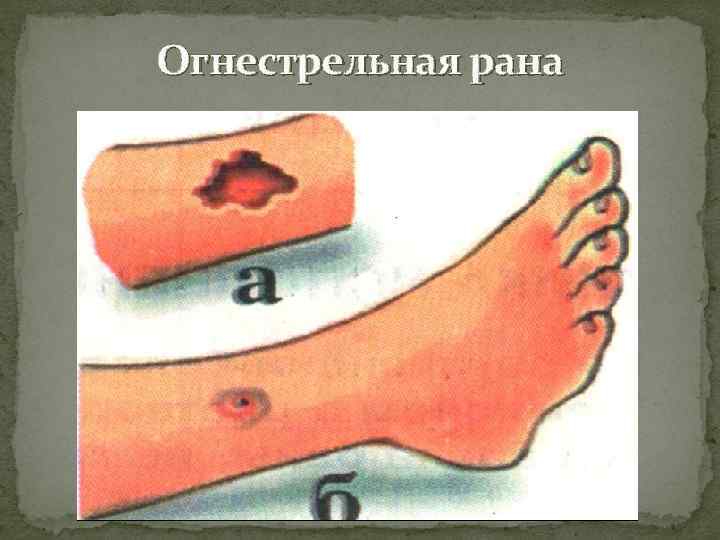Огнестрельная рана 