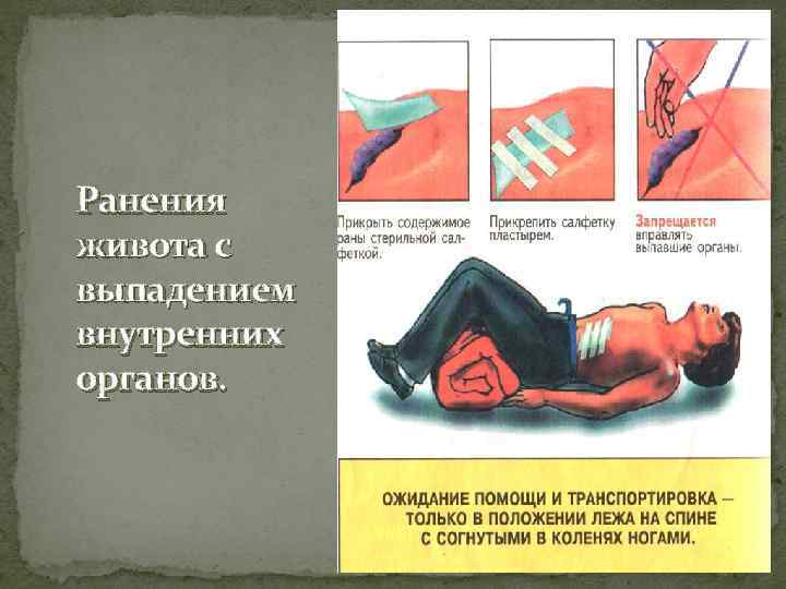 Ранения живота с выпадением внутренних органов. 