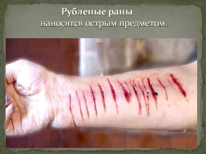   Рубленые раны наносятся острым предметом. 