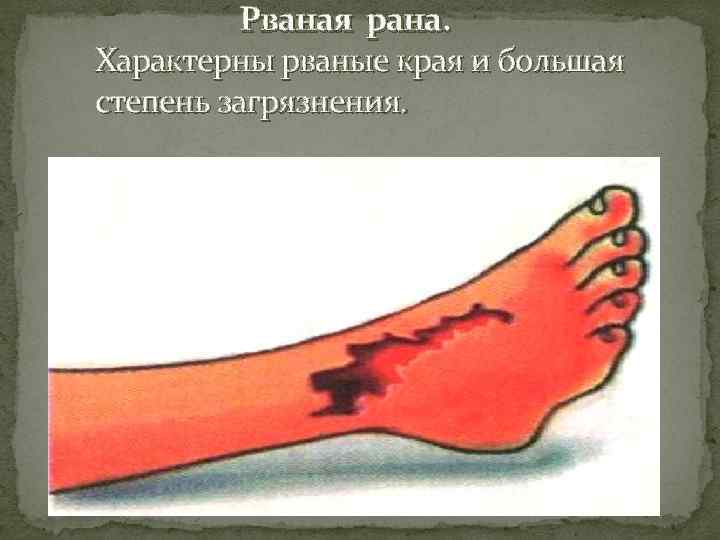    Рваная рана. Характерны рваные края и большая степень загрязнения. 