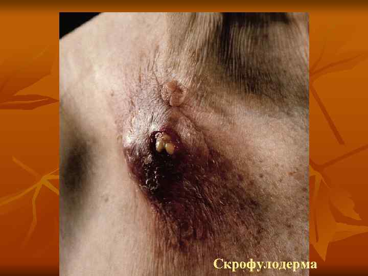 Скрофулодерма 