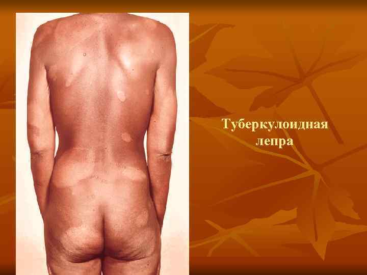 Туберкулоидная лепра 