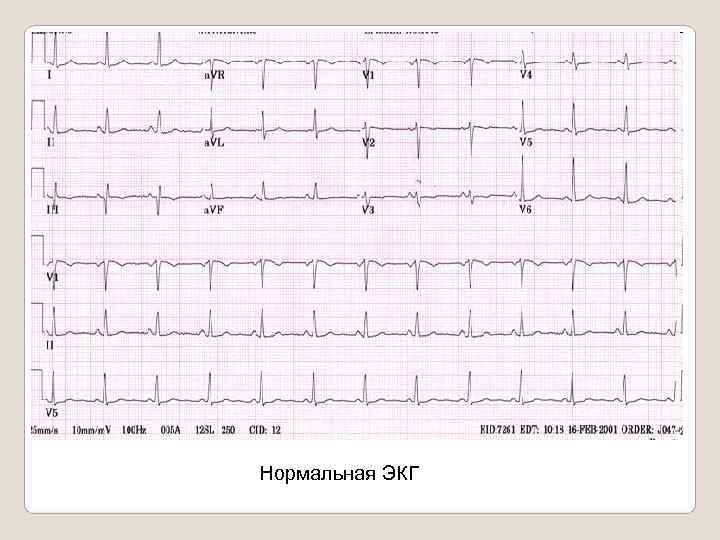 Нормальная ЭКГ 