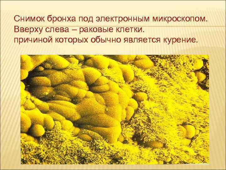 Снимок бронха под электронным микроскопом. Вверху слева – раковые клетки. причиной которых обычно является