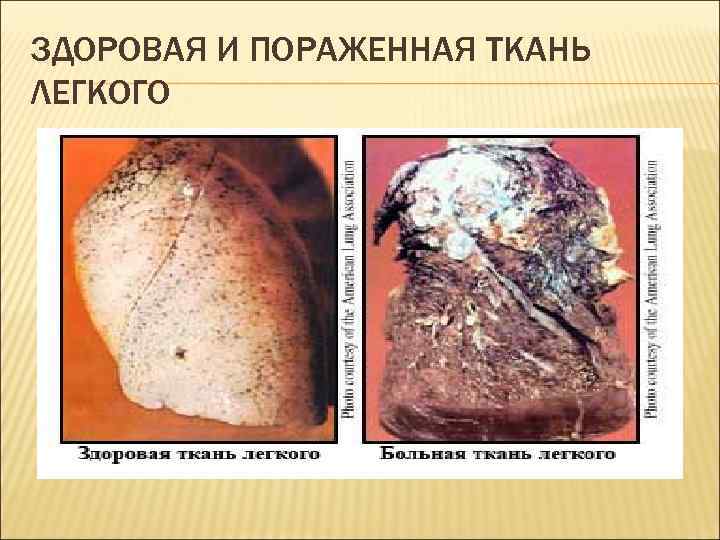 ЗДОРОВАЯ И ПОРАЖЕННАЯ ТКАНЬ ЛЕГКОГО 