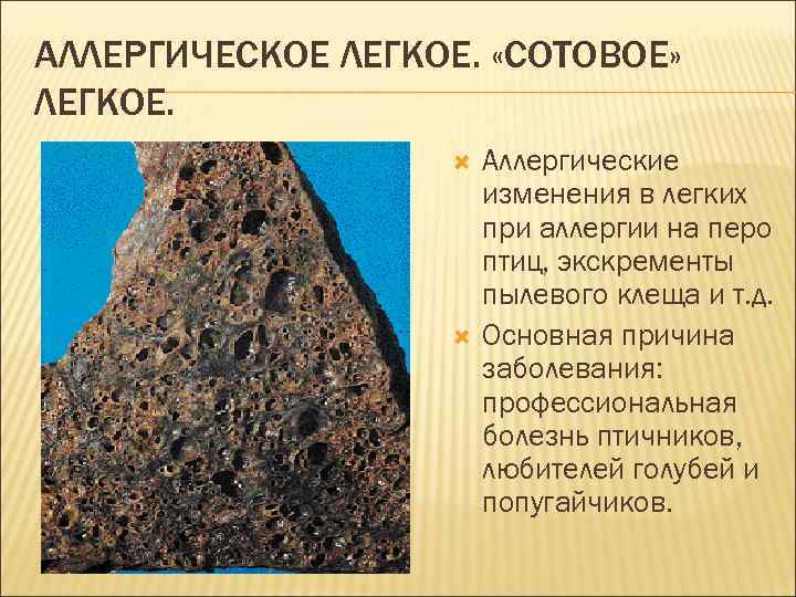 АЛЛЕРГИЧЕСКОЕ ЛЕГКОЕ.  «СОТОВОЕ» ЛЕГКОЕ.     Аллергические    