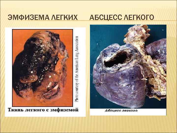 ЭМФИЗЕМА ЛЕГКИХ  АБСЦЕСС ЛЕГКОГО 