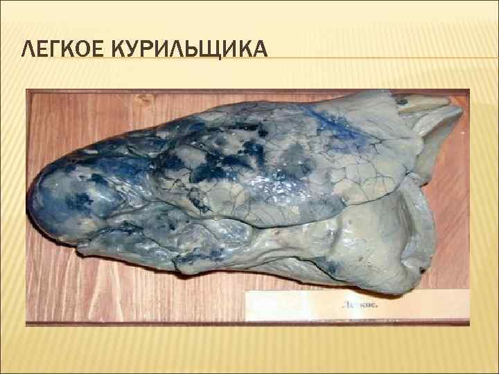 ЛЕГКОЕ КУРИЛЬЩИКА 