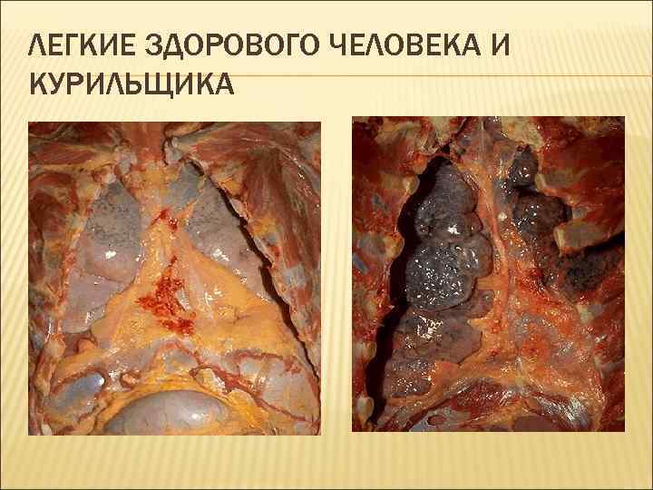 ЛЕГКИЕ ЗДОРОВОГО ЧЕЛОВЕКА И КУРИЛЬЩИКА 