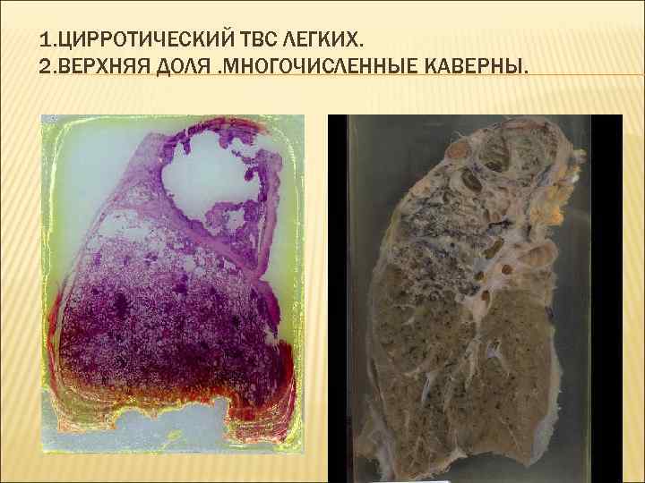 1. ЦИРРОТИЧЕСКИЙ ТВС ЛЕГКИХ. 2. ВЕРХНЯЯ ДОЛЯ. МНОГОЧИСЛЕННЫЕ КАВЕРНЫ. 