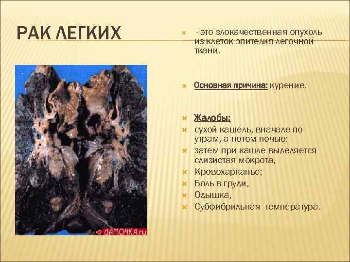 РАК ЛЕГКИХ  - этозлокачественная опухоль   из клеток эпителия легочной  