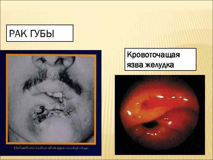 РАК ГУБЫ  Кровоточащая  язва желудка 