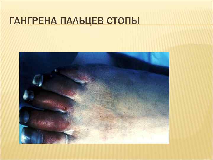 ГАНГРЕНА ПАЛЬЦЕВ СТОПЫ 