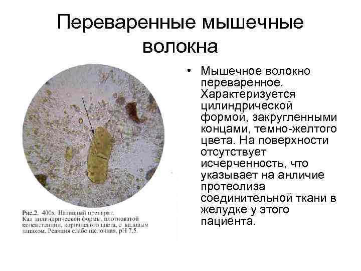 Переваренные мышечные  волокна   • Мышечное волокно   переваренное.  