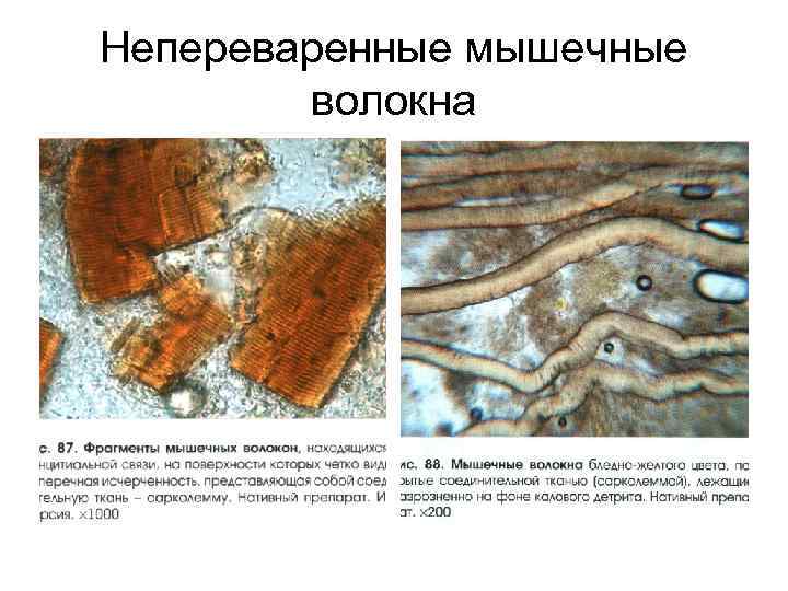 Непереваренные мышечные   волокна 