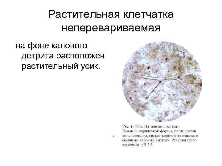  Растительная клетчатка   неперевариваемая на фоне калового детрита расположен растительный усик. 
