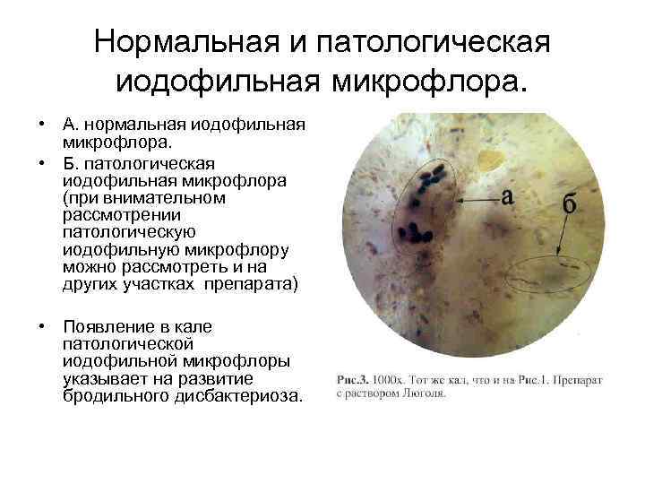  Нормальная и патологическая  иодофильная микрофлора.  • А. нормальная иодофильная  микрофлора.