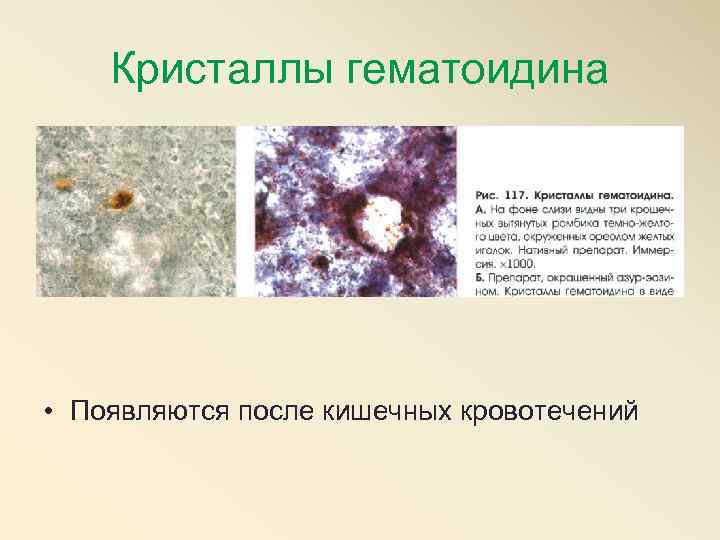   Кристаллы гематоидина • Появляются после кишечных кровотечений 