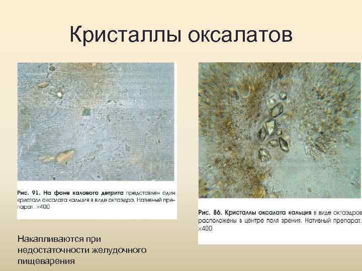    Кристаллы оксалатов Накапливаются при недостаточности желудочного пищеварения 