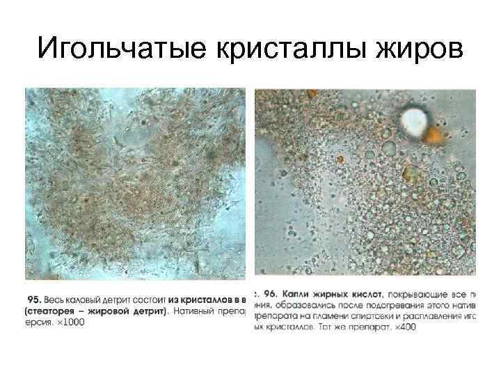 Игольчатые кристаллы жиров 