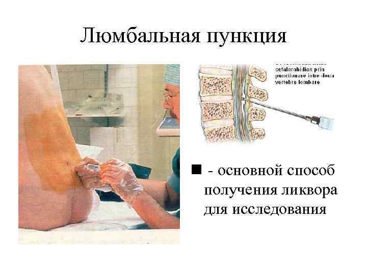 Люмбальная пункция   n - основной способ  получения ликвора  для исследования