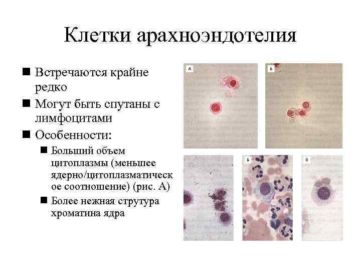  Клетки арахноэндотелия n Встречаются крайне  редко n Могут быть спутаны с 