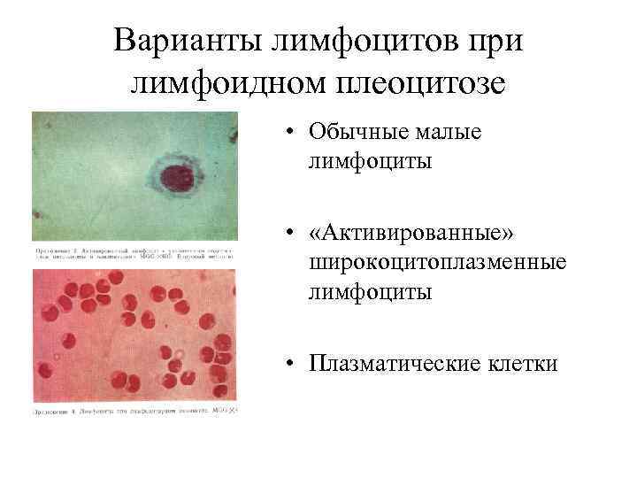 Варианты лимфоцитов при лимфоидном плеоцитозе  • Обычные малые  лимфоциты  • 