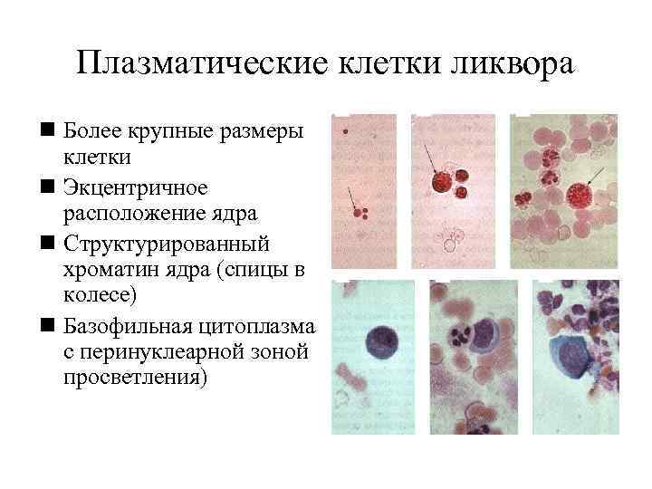   Плазматические клетки ликвора n Более крупные размеры  клетки n Экцентричное 