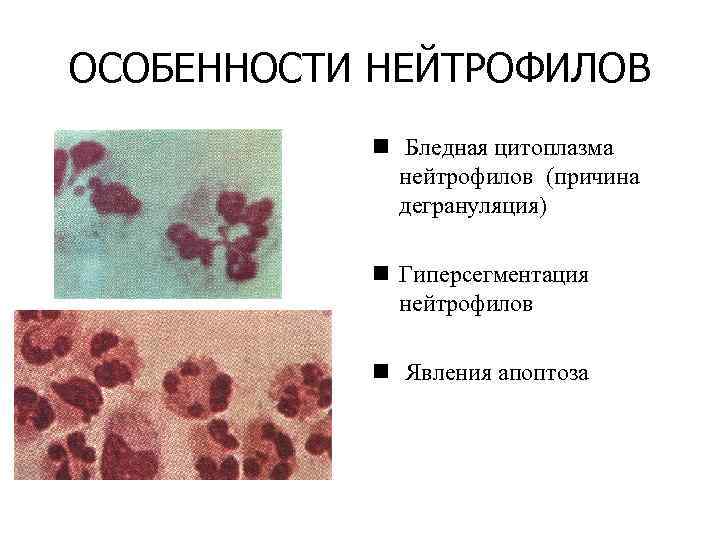 ОСОБЕННОСТИ НЕЙТРОФИЛОВ  n Бледная цитоплазма   нейтрофилов (причина   дегрануляция) 