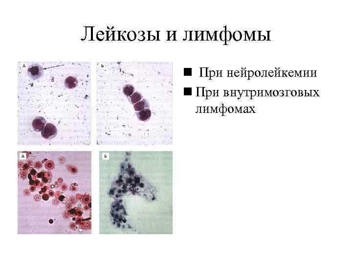 Лейкозы и лимфомы   n При нейролейкемии   n При внутримозговых 